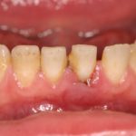Как происходит снятие зубных отложений с помощью ультразвука