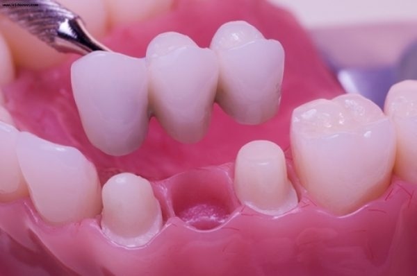 Протезирование зубов с разных точек зрения