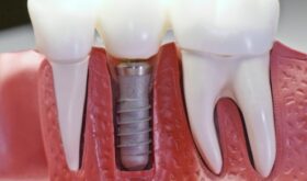 Имплантация зубов – от планов к действиям