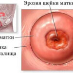 Эрозия шейки матки