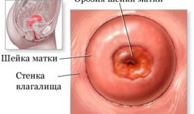 Эрозия шейки матки