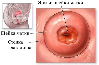 Эрозия шейки матки