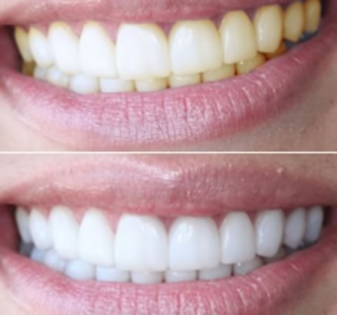 Как добиться наилучшего результата при лазерном отбеливании зубов без пагубных последствий