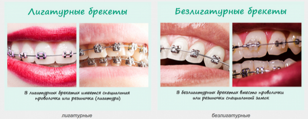 Очаровательная улыбка с брекет-системой. Виды брекетов