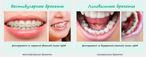 Очаровательная улыбка с брекет-системой. Виды брекетов