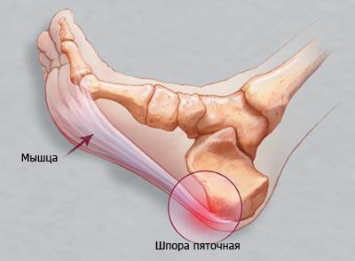 Симптомы, диагностика и лечение пяточной шпоры