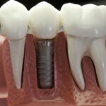 Применение имплантатов – новая эра в ортодонтии