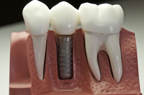 Применение имплантатов – новая эра в ортодонтии