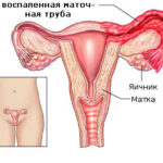 Воспаление придатков матки и яичников: аднексит, сальпингит и оофорит