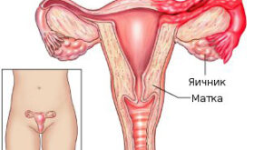 Воспаление придатков матки и яичников: аднексит, сальпингит и оофорит