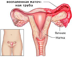 Воспаление придатков матки и яичников: аднексит, сальпингит и оофорит