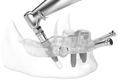 Хирургические шаблоны для имплантации зубов