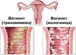 Вагинит (кольпит), вульвовагинит, вульвит