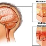 Менингит: возбудители, анализы, курс лечения