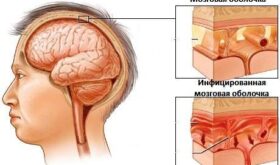 Менингит: возбудители, анализы, курс лечения