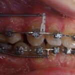 Применение микроимплантов — прорыв в ортодонтии