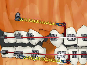 Применение микроимплантов — прорыв в ортодонтии