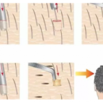Основные методы пересадки волос для мужчин