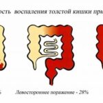 Колит: причины, виды воспалений