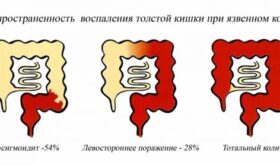 Колит: причины, виды воспалений