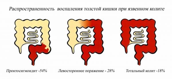 Колит: причины, виды воспалений