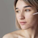 Почему акне не проходит: 9 причин, о которых вы не задумывались