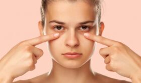 Эффект панды: как избавиться от темных кругов под глазами, 5 рабочих методов