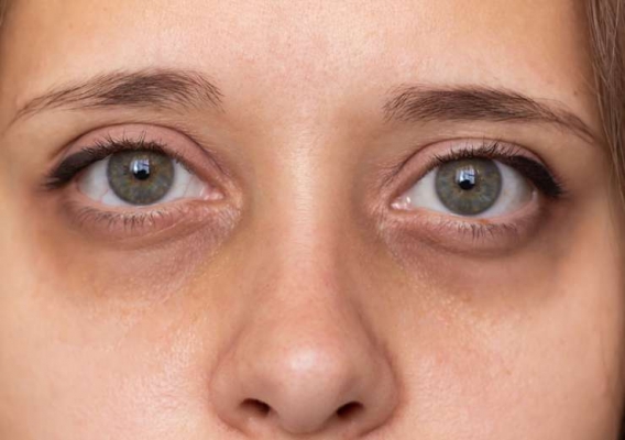 Эффект панды: как избавиться от темных кругов под глазами, 5 рабочих методов