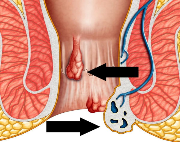 Геморрой — это не табу